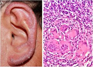 (A e B) lesão eritematoescamosa, infiltrativa, na orelha esquerda. Histopatológico: infiltrado inflamatório granulomatoso com focos supurativos (Hematoxilina & eosina, 400×).