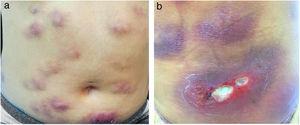 (A e B) Nódulos e placas eritêmato‐infiltrados, alguns com ulceração e supuração.