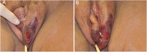 Gangrena de Fournier de localização vulvar pós‐depilação. Presença de edema, eritema e sinais de necrose.