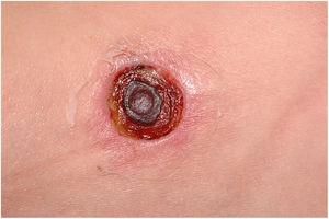 Ectima gangrenoso por Pseudomonas aeruginosa. Detalhe de lesão ulceronecrótica e borda ativa, infiltrada eritemato‐edematosa.