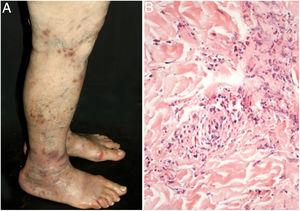 Vasculite cutânea de pequenos vasos limitada à pele: (A) púrpura palpável e úlceras necróticas nos membros inferiores; (B) necrose de células endoteliais de vênulas da derme papilar superficial com deposição de fibrina, infiltrado de neutrófilos e leucocitoclasia.