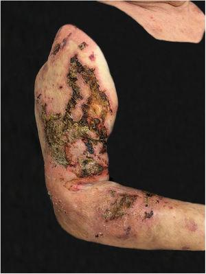 Paracoccidioidomicose: lesões ulceronecróticas, fagedênicas, com áreas recobertas por crostas, acometem braço e antebraço direito.