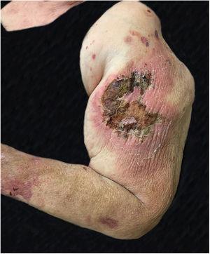 Paracoccidioidomicose: lesão ulceronecrótica extensa, áreas recobertas por crostas e com halo inflamatório intenso. Pápulas e placas satélites. Localizadas no braço e antebraço esquerdo.