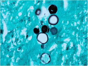 Paracoccidioidomicose: Paracoccidioides spp. Células fúngicas exibem o clássico Mickey Mouse (Grocott Gomeri. Imersão, 1000×).
