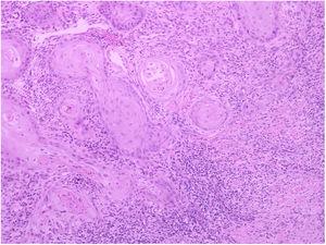 Exame anatomopatológico revela carcinoma epidermoide moderadamente diferenciado com invasão da derme reticular (Hematoxilina & eosina, 20×).
