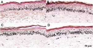Fragmentos histológicos de pele corados pelo Fontana‐Masson de melasma facial e pele normal adjacente antes e após irradiação com 166mJ/cm2 UVB, revelam aumento da densidade de melanina basal entre as amostras. A, Pele normal adjacente pré‐irradiação UVB; B, pele normal adjacente pós‐irradiação UVB; C, pele com melasma pré‐irradiação UVB; D, pele com melasma pós‐irradiação com UVB.