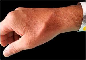 Nódulo subcutâneo linear no dorso da mão direita.