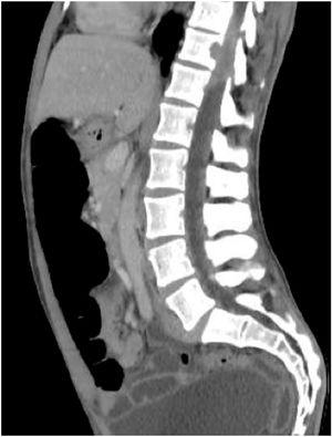 Ressonância magnética nuclear da coluna vertebral com infiltração epidural e envolvimento foraminal de T11 e T12 com compressão e deslocamento da medula espinal.