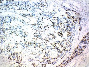 Painel imuno‐histoquímico do linfonodo acometido evidenciou expressão para proteína p63, favorecendo o diagnóstico de hidroadenocarcinoma metastático (P63, 100×).