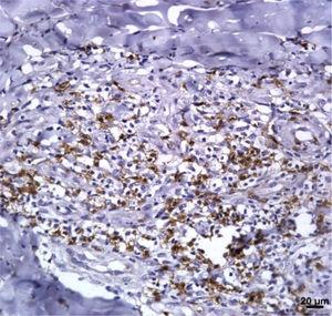 Fragmento de pele de úlcera de leishmaniose cutânea evidenciando células T CD8+ na imuno‐histoquímica (400×).