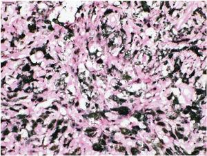 Presença de macrófagos abarrotados de pigmento melânico (melanófagos), melhor evidenciados no H&E após contracoloração com Giemsa.