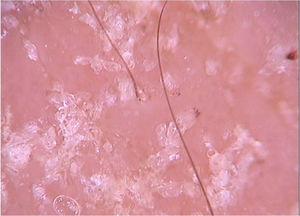 Imagem dermatoscópica de eritrodermia por escabiose demonstrando o noodle sign (Fotofinder, magnitude original 20×). Fonte: Acervo do Hospital de Clínicas de Porto Alegre.