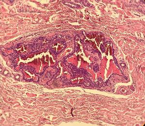 Ao centro do corte, observa‐se um ninho composto por células glômicas, com núcleos regulares e monomórficos, circundando espaços vasculares. A derme adjacente apresenta espessamento das fibras colágenas (Hematoxilina & eosina, 400×).