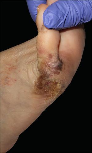 Melanoma lentiginoso acral nas superfícies plantar e lateral do pé direito.