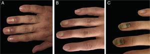 Imagens clínicas do caso 1. (A), Edema acentuado das pregas ungueais do terceiro e quarto dedos. (B), Regressão do edema. (C), Onicomadese nos dois dedos.