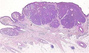 O exame histopatológico da lesão revelou um tumor nodular estendendo‐se da epiderme até a derme média (Hematoxilina & eosina, 20×).
