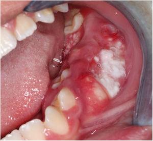 Apresentação clínica: tumoração envolvendo a gengiva vestibular e lingual entre o segundo molar inferior esquerdo e o primeiro pré‐molar esquerdo inferior.