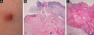 (A), Nódulo firme e eritematoso com crostas centrais na parte superior do braço. (B), Pilomatricoma com a eliminação das células do pilomatricoma (Hematoxilina & eosina, 40×). (C), Histopatologia de outro nódulo, mostrando ulceração central e massa tumoral eosinofílica com células tumorais basalóides periféricas (Hematoxilina & eosina, 40×).