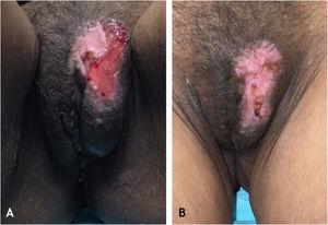 (A), Úlcera extensa com crosta na região da vulva. (B), Aspecto cicatricial da lesão após associação do uso de imiquimode creme a 5%.