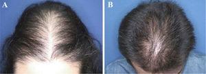 Padrões de queda de cabelos observados na alopecia androgenética pediátrica. (A), Padrão em “árvore de Natal” em uma paciente do sexo feminino com alopecia androgenética na adolescência. (B), Recessão bitemporal, frontoparietal e no vértice em um paciente do sexo masculino com alopecia androgenética na adolescência.