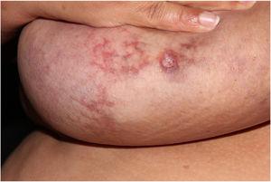Mamas grandes e pêndulas com placas reticuladas eritematovioláceas e algumas áreas ulceradas.