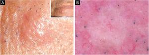 (A), Pápula normocrômica, firme e não dolorosa, com diâmetro de 4 × 5mm. (B), Área homogênea, sem estruturas, de cor rósea‐esbranquiçada na dermatoscopia.