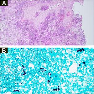 (A), Histopatologia da amostra cirúrgica da segunda paciente demonstrando hiperplasia pseudoepiteliomatosa, exocitose de neutrófilos e linfócitos, edema difuso e células inflamatórias mistas com formação de micro‐abscessos na derme, aumento de vasos capilares e hifas fúngicas (estruturas basófilas globulares) nas células gigantes multinucleadas (Hematoxilina & eosina, 100×). (B), Hifas septadas ramificadas na coloração pela prata metenamina de Grocott e múltiplas estruturas redondas semelhantes a leveduras com pseudobrotamento (400×).