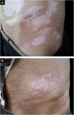 (A), Paciente do sexo masculino com várias manchas despigmentadas no tronco. (B), Resultado do tratamento com taxa de repigmentação superior a 50% após 18 meses.