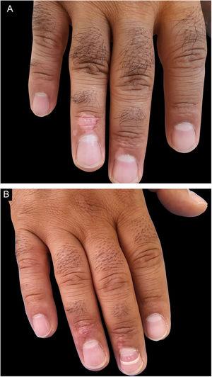 (A), Paciente do sexo masculino com manchas de vitiligo na região acral. (B), Resultado do tratamento com excelente desfecho após 18 meses.