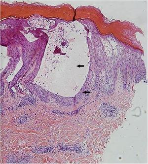 Biópsia de pele do braço mostrando hiperceratose, espongiose intensa na epiderme (Hematoxilina & eosina, 40×).