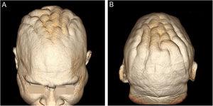 (A e B), Reconstrução tridimensional (3D) cerebriforme da pele a partir da ressonância magnética do segmento cefálico.