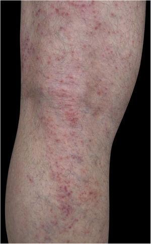 Eczema no membro inferior por dermatite alérgica de contato a corticosteroide.