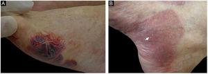 Paciente número 4 nas tabelas 1 e 2. (A), Bolha hemorrágica e tensa sobre placas eritematosas no pé. (B), Lesões de milia (seta branca) sobre lesões cicatriciais podem ser vistas.