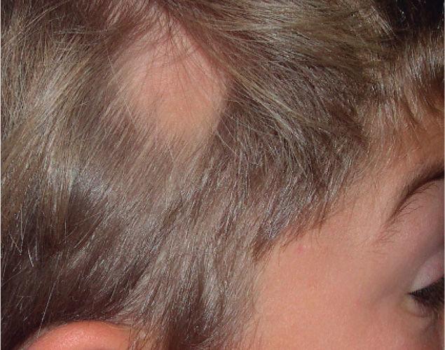 Alopecia triangular congénita bilateral asociada a cardiopatía