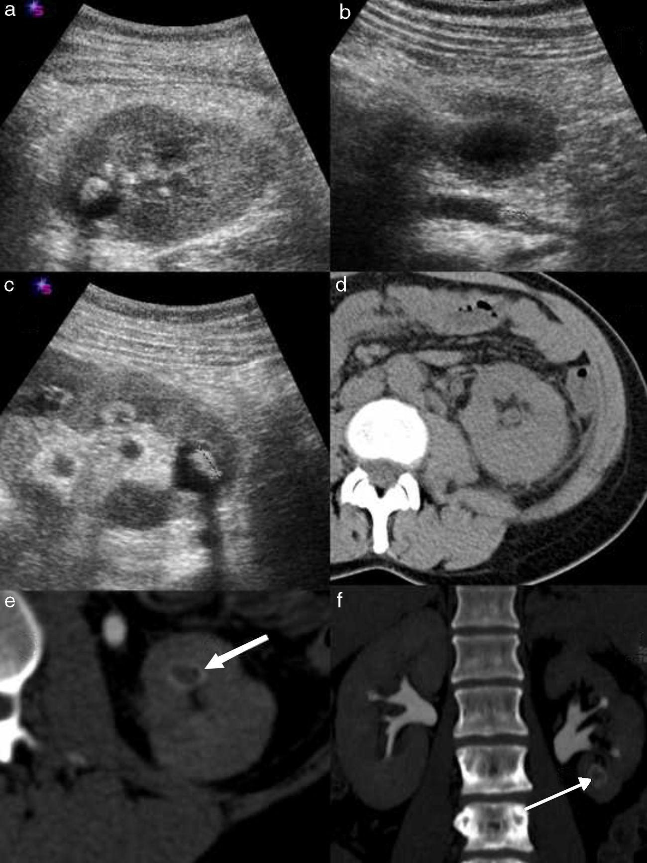 Manejo diagnóstico del cólico renal | Radiología