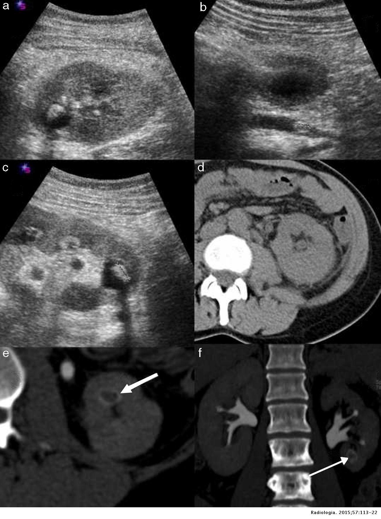 Manejo diagnóstico del cólico renal | Radiología