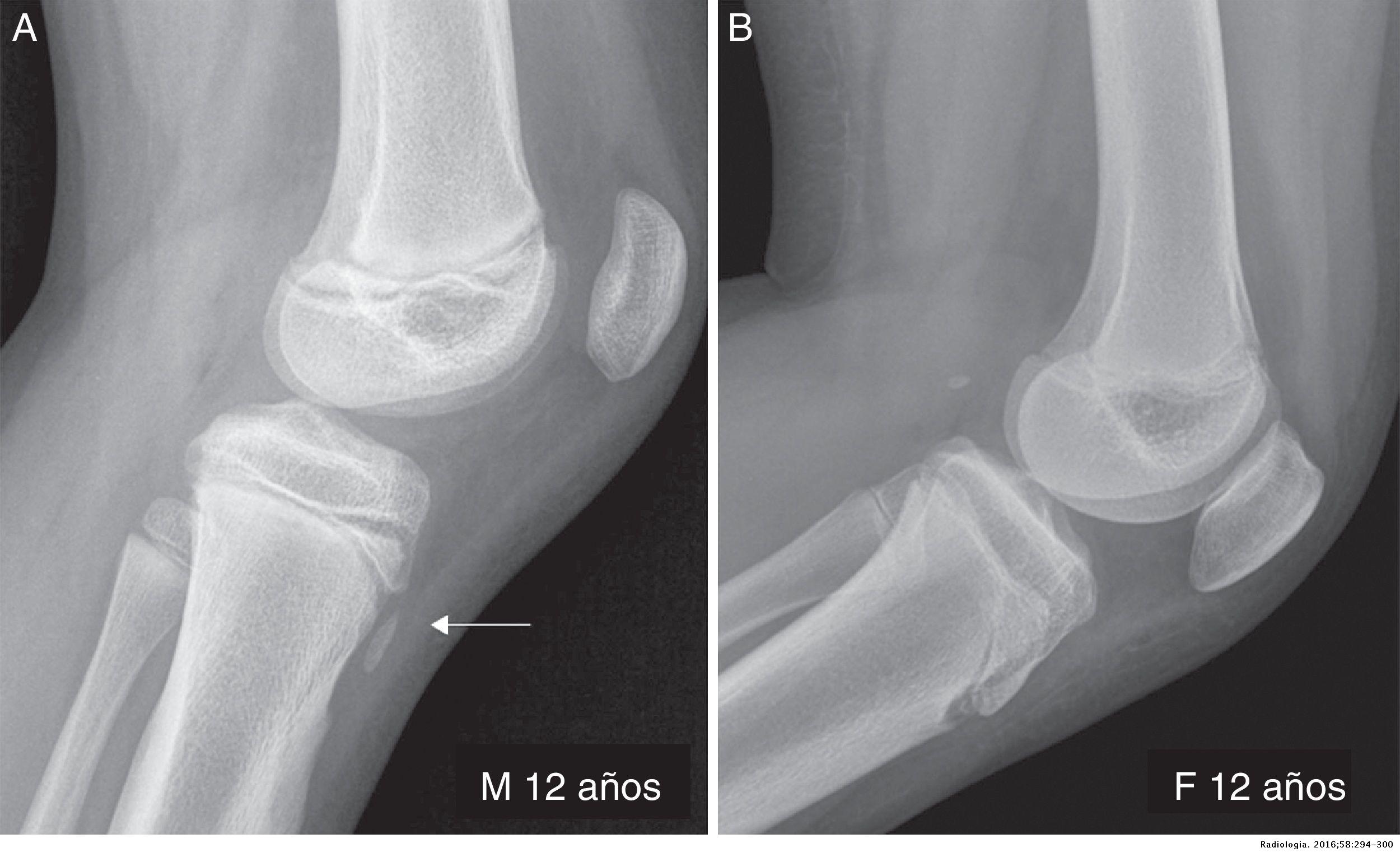 Características radiológicas del desarrollo de la tuberosidad tibial ...