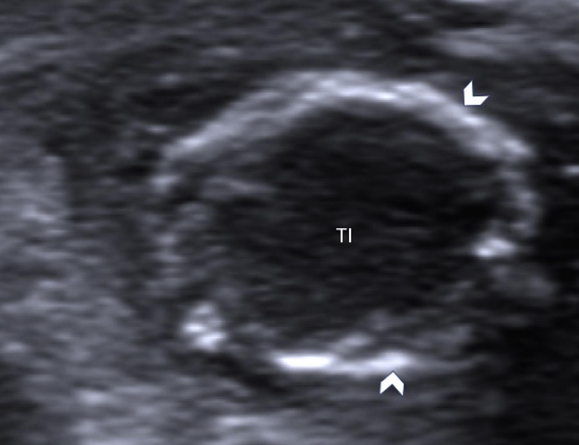 Torsión Testicular Perinatal Valoración Ecográfica Y Diagnóstico