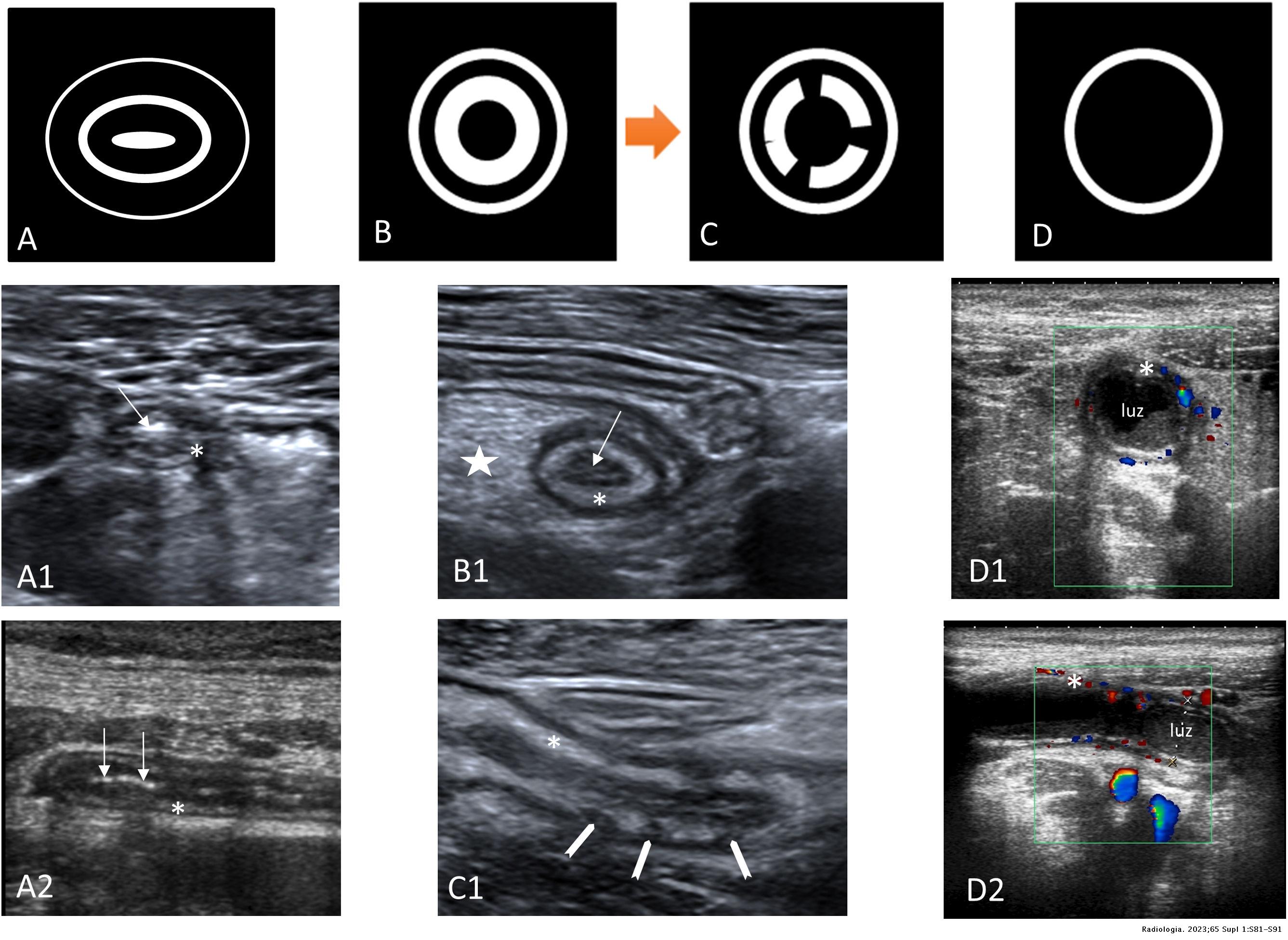 Actualización de la apendicitis aguda: hallazgos típicos y atípicos ...
