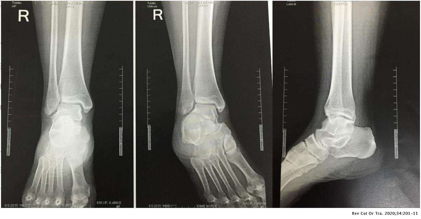 Evaluation of ankle conventional x-ray as a gold standard on diagnosis ...