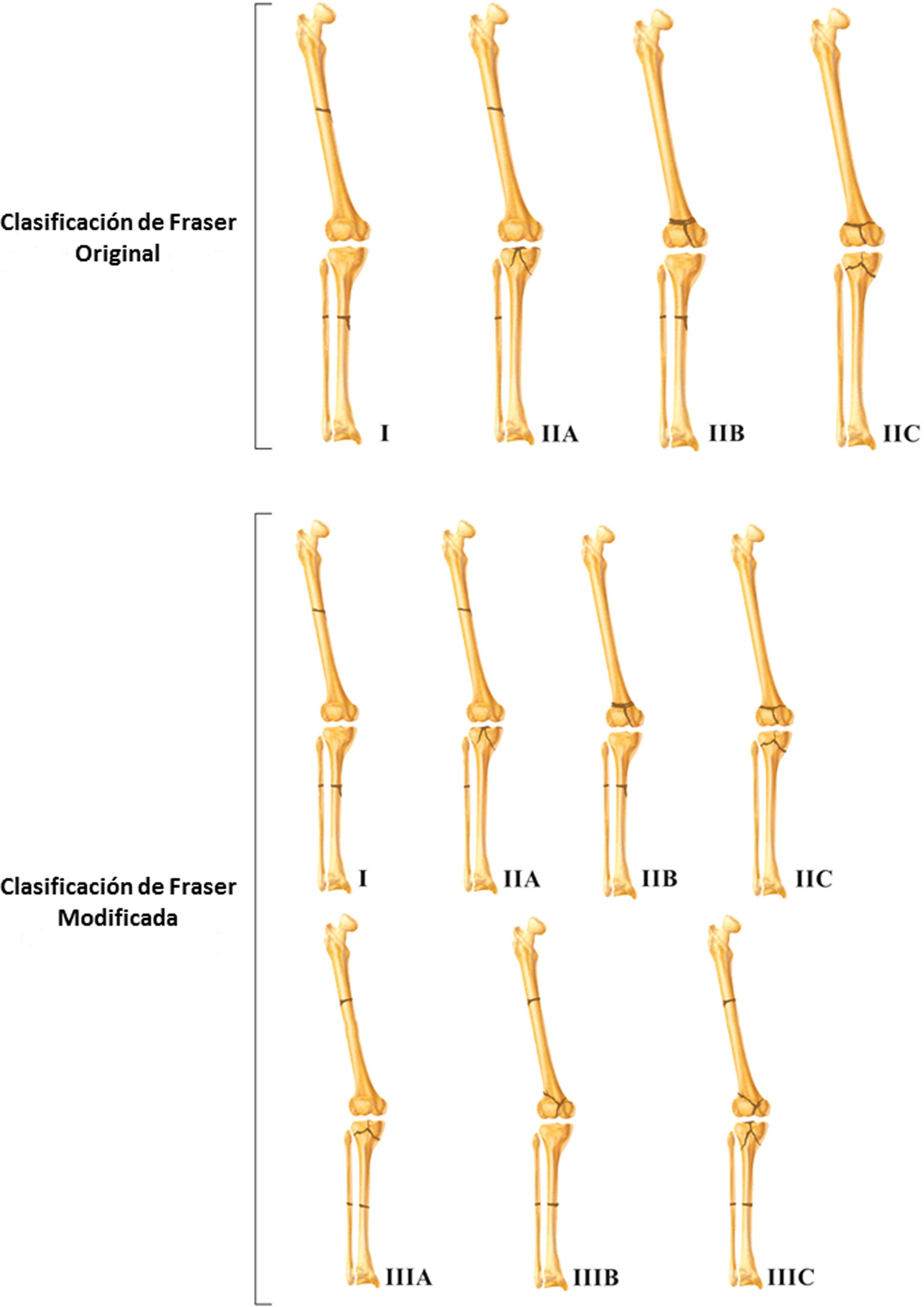 Rodilla Flotante: Modificación De La Clasificación De Fraser Y Factores ...