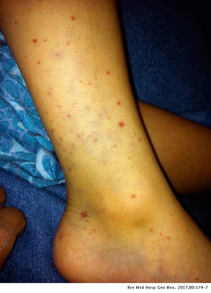 Congenital Cmv Rash