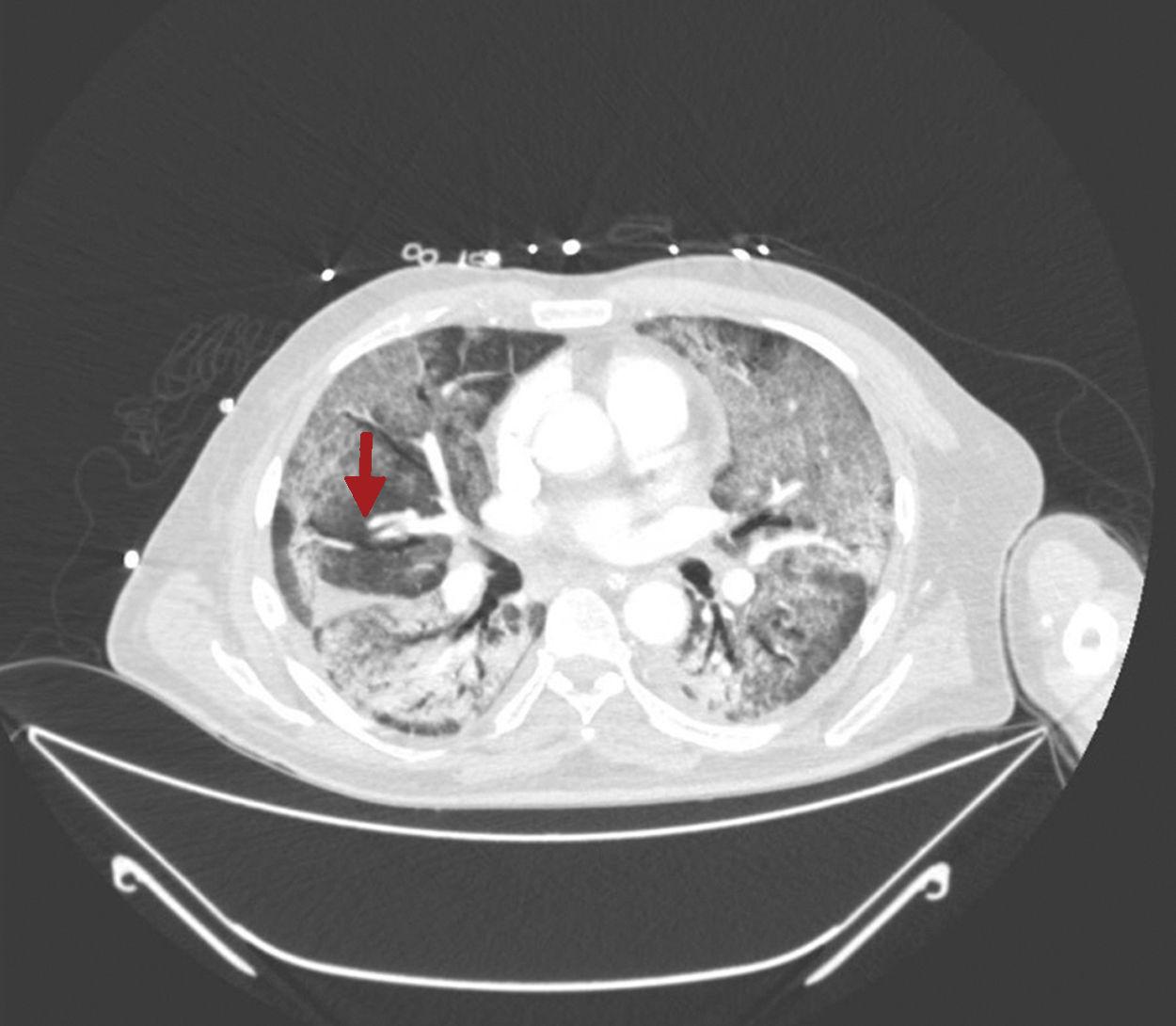 Tromboembolismo Pulmonar Periférico En Neumonía Bilateral Por Covid 19
