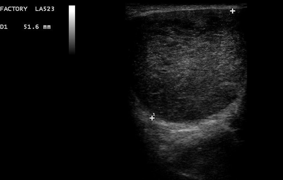 Tumoración Perianal Que Simulaba Ser Un Absceso Gastroenterología Y Hepatología 