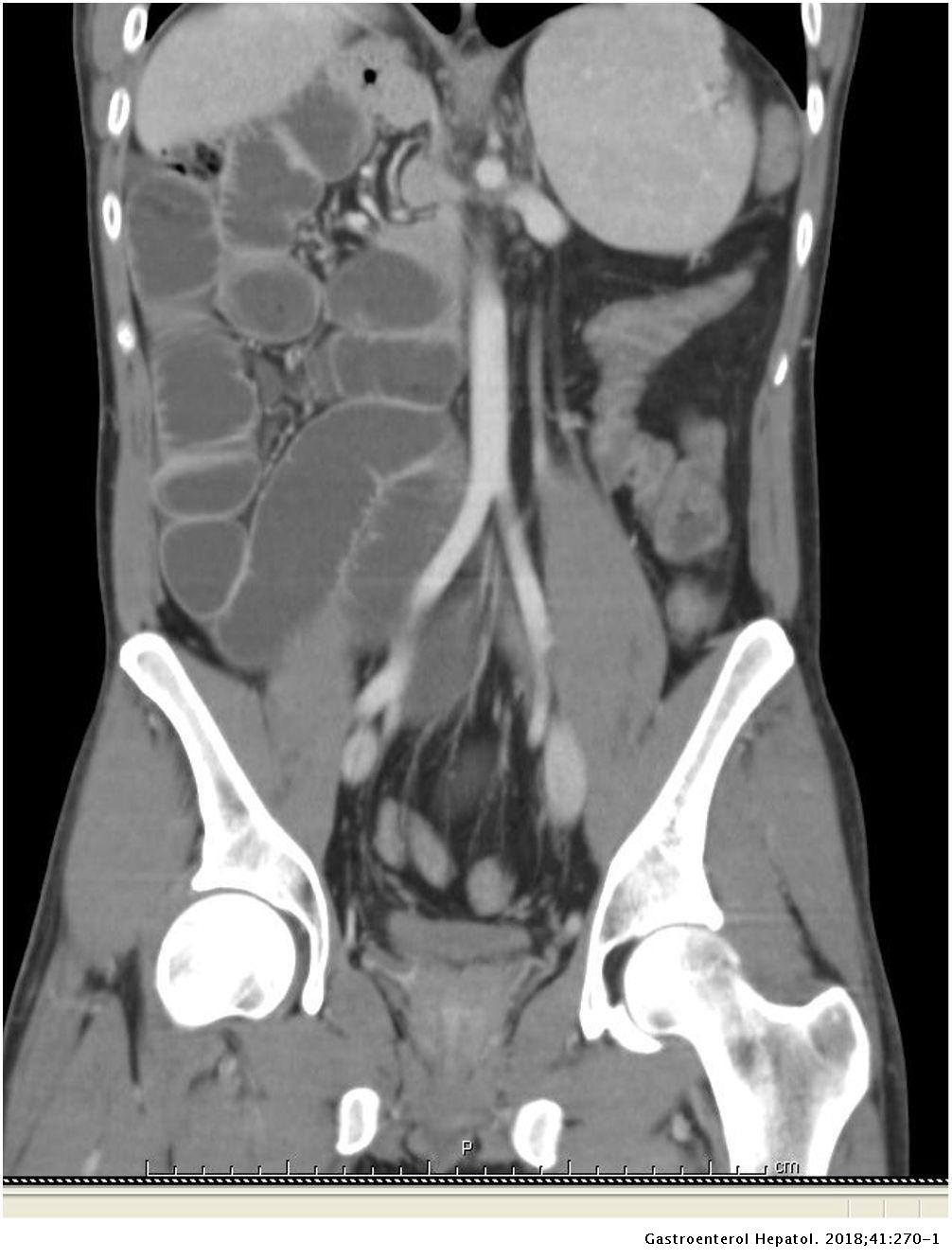 Intestinal malrotation: A rare cause of chronic recurrent abdominal ...