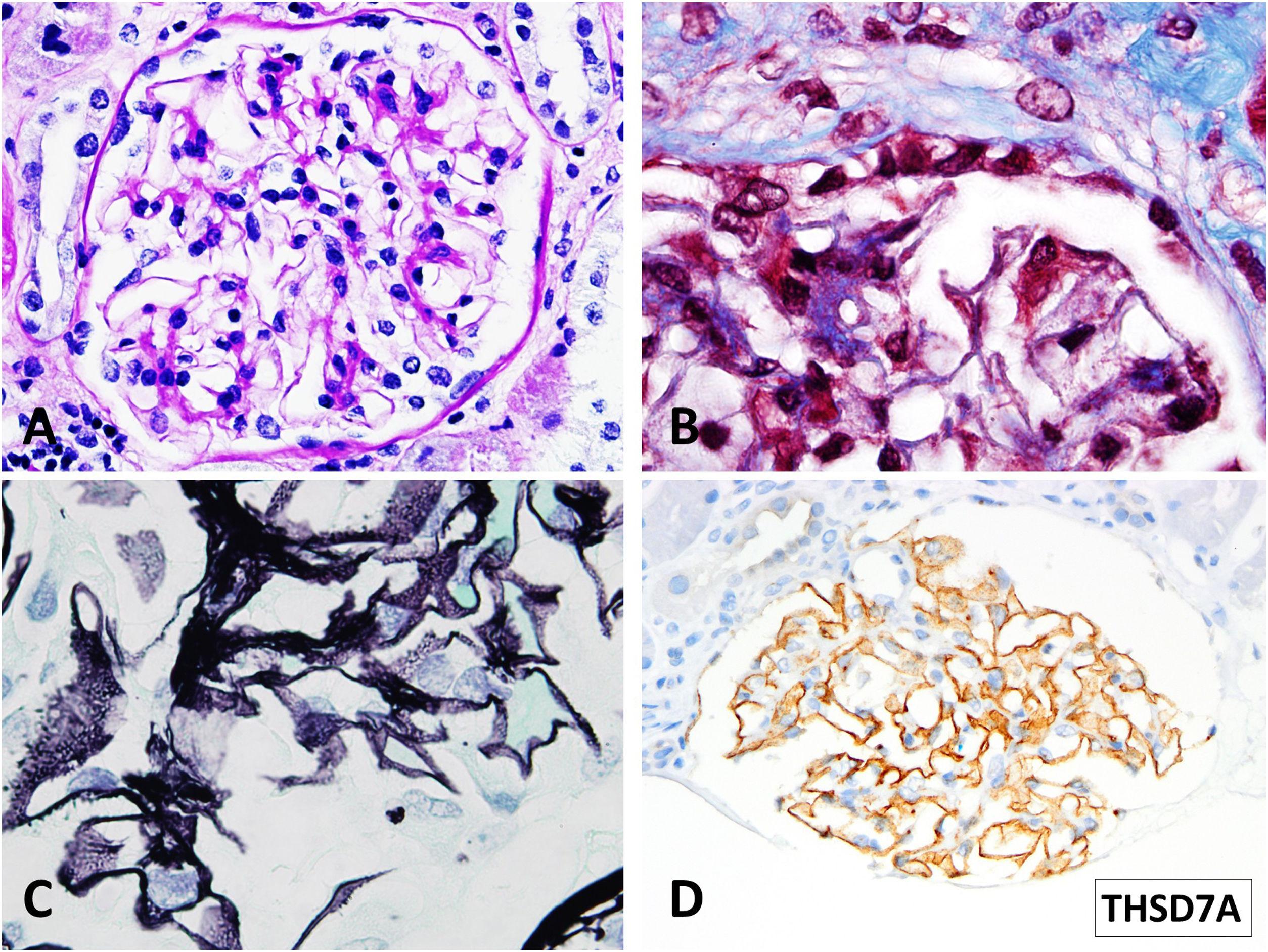 THSD7A-positive membranous nephropathy after kidney transplantation: A ...