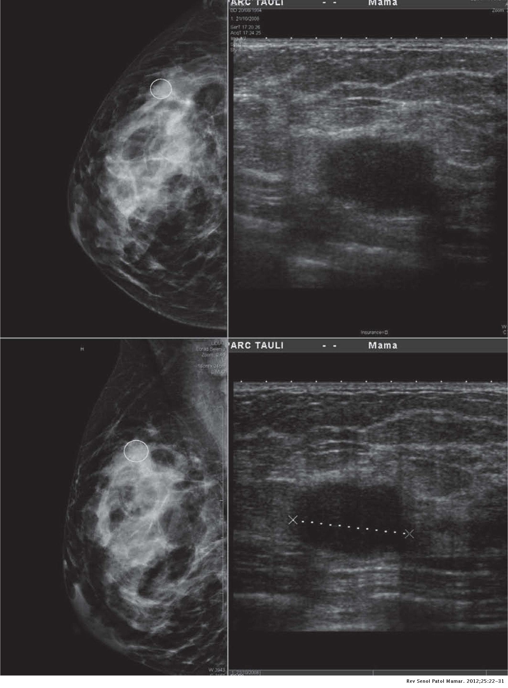 Características de imagen del carcinoma triple negativo Revista de Senología y Patología Características de imagen del carcinoma triple negativo Revista de Senología y Patología