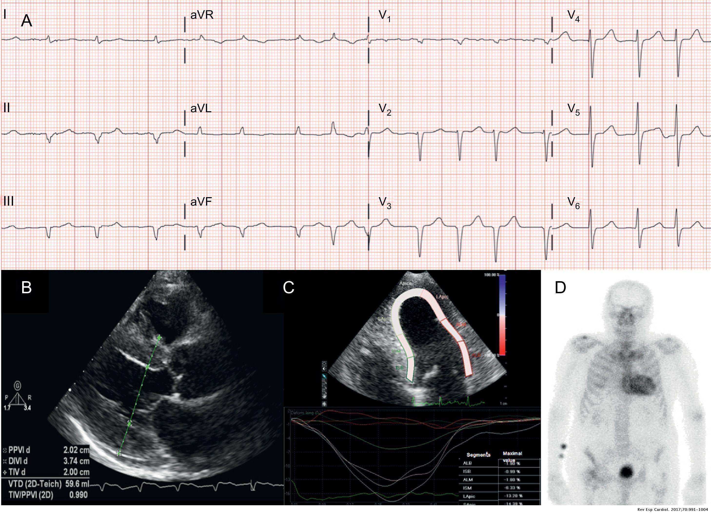 Diagnóstico y tratamiento de la amiloidosis cardiaca por transtiretina Diagnóstico y tratamiento de la amiloidosis cardiaca por transtiretina