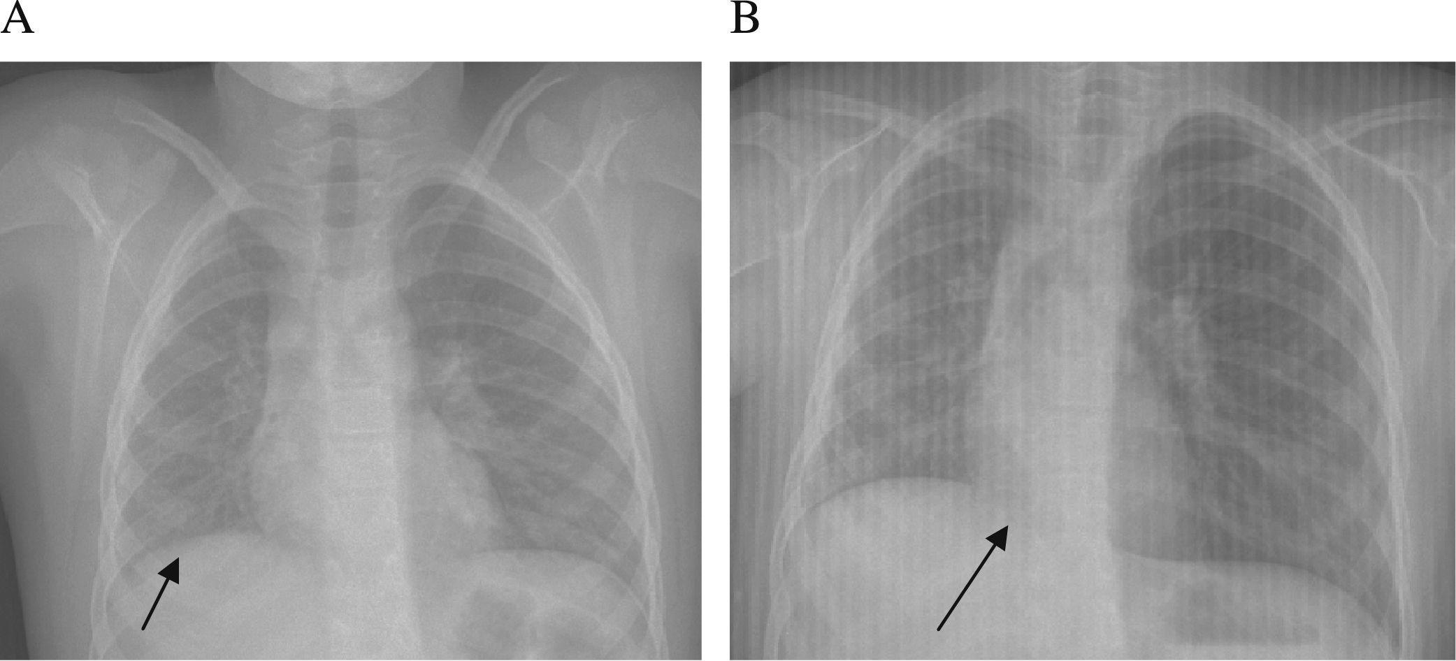 Pulmonary agenesis Importance of the diagnosis Allergologia et