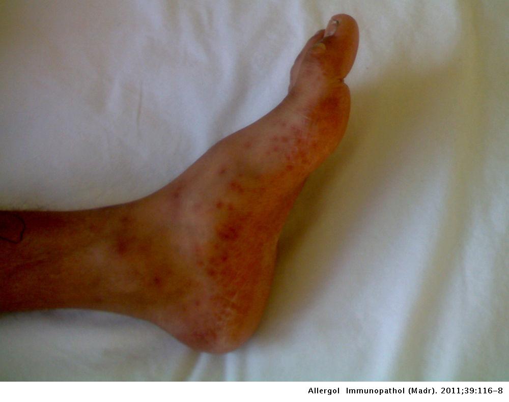 EBV-induced erythema multiforme: a case report | Allergologia et ...